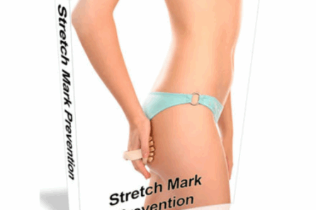 stretch-marks-prevention-and-treatment