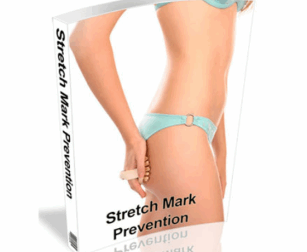 stretch-marks-prevention-and-treatment